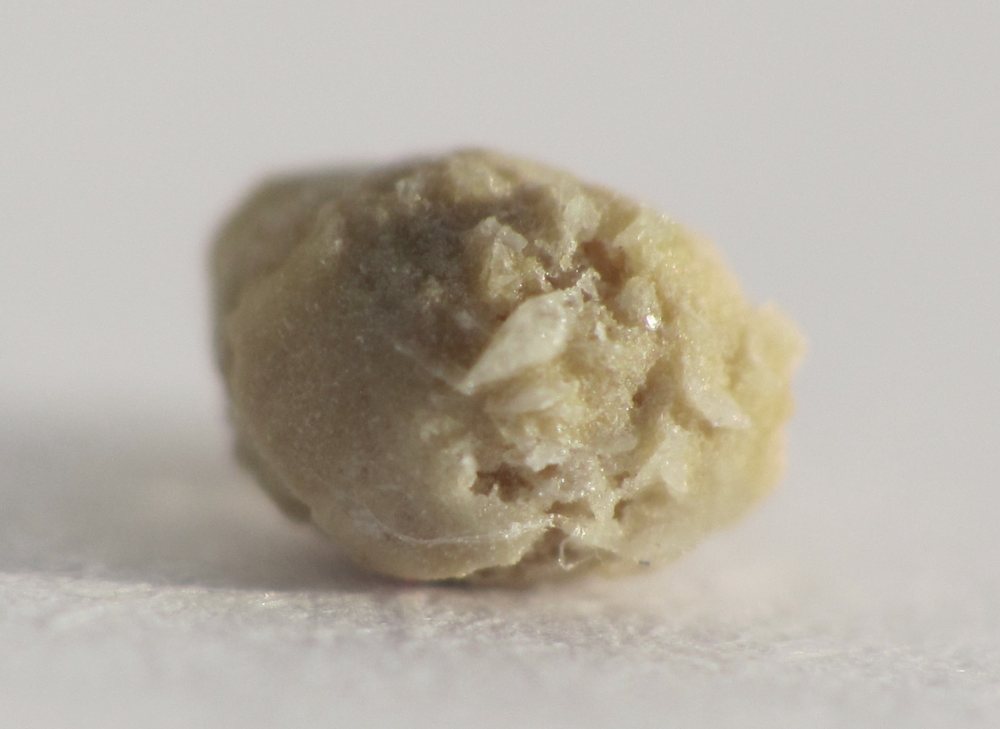 Calcolo renale di circa 4 millimetri espulso spontaneamente