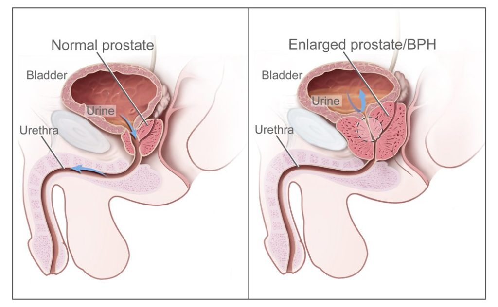 Laser Green: vaporizzazione dell’adenoma prostatico