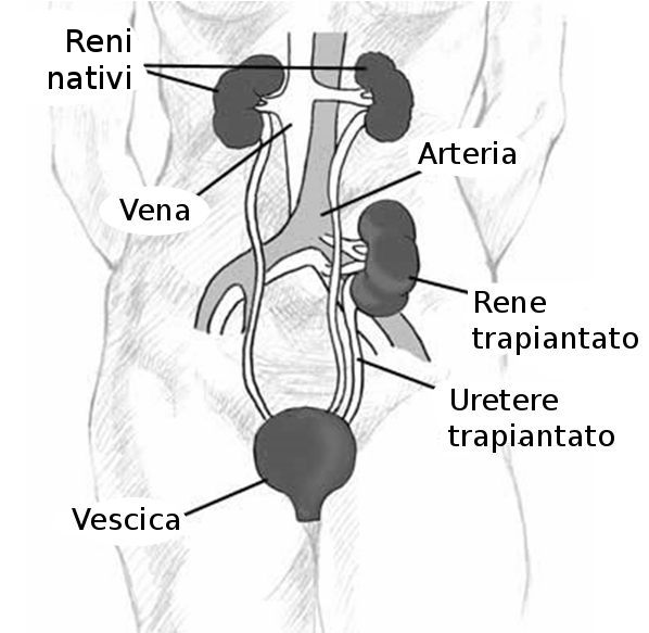 Schema del trapianto di rene: reni nativi, rene trapiantato, uretere trapiantato e vescica